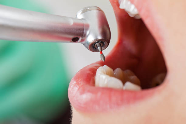Best Emergency Dentist for Knocked-Out Tooth in Four Square Mile, CO